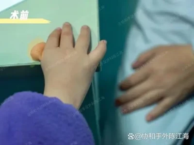 Floating Thumb: Successful Preservation of Five Fingers|Μελέτη περίπτωσης 5-Έ...