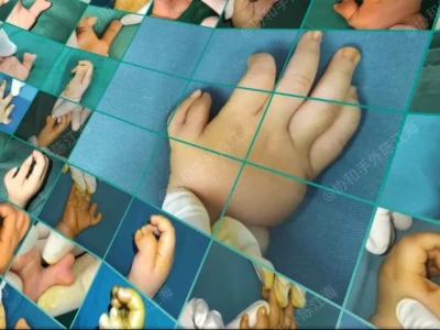 300 ημέρες με ένα μωρό που γεννήθηκε με polydactyly: βασικά ορόσημα στην προε...